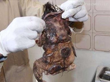 عکس های چندش آور جنینی در شکم یک پسر (16+)