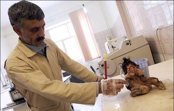 عکس های چندش آور جنینی در شکم یک پسر (16+)