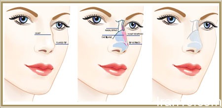 رینوپلاستی چیست, سن عمل جراحی بینی