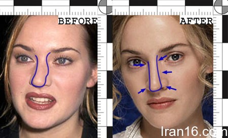 عوارض جراحی بینی, انحراف بینی