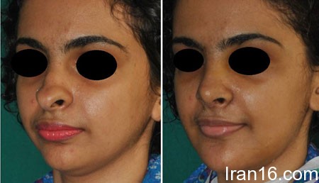 عوارض جراحی بینی, انحراف بینی