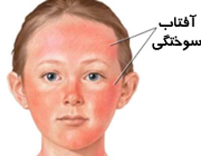 از بین بردن سریع آفتاب سوختگی پوست صورت آفتاب سوختگی,درمان آفتاب سوختگی,آفتاب سوختگی صورت