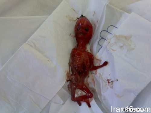 خبر جنجالی زایمان دختر در دستشویی مدرسه + عکس