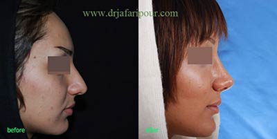 جراحی زیبایی بینی,جراحی بینی,جراحی پلاستیک بینی جراحی زیبایی بینی,جراحی بینی,جراحی پلاستیک بینی