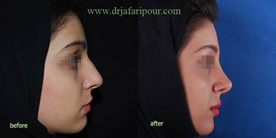 جراحی زیبایی بینی,جراحی بینی,جراحی پلاستیک بینی جراحی زیبایی بینی,جراحی بینی,جراحی پلاستیک بینی