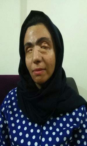 رازهای تکاندهنده از زندگی قربانیان ایرانی اسید پاشی + عکس 18 +