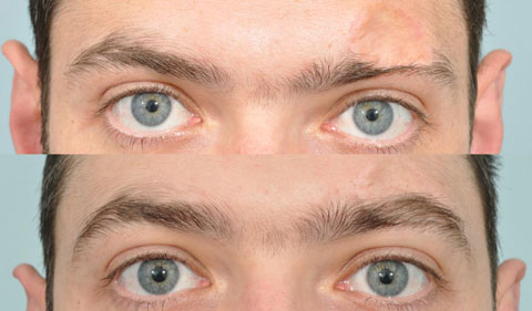 کاشت تاج ابرو,هزینه کاشت ابرو,کلینیک زیبایی