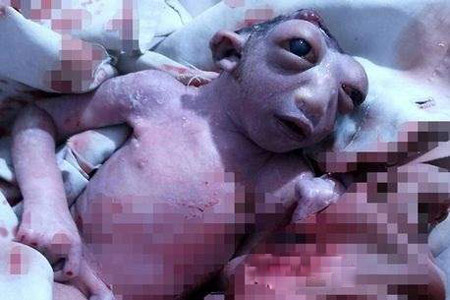 تولد نوزاد عجیب و غریب با سر نیمه +عکس تولد نوزاد عجیب و غریب با سر نیمه +عکس