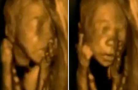 رقص جنین در شکم مادر رقص جنین در شکم مادر