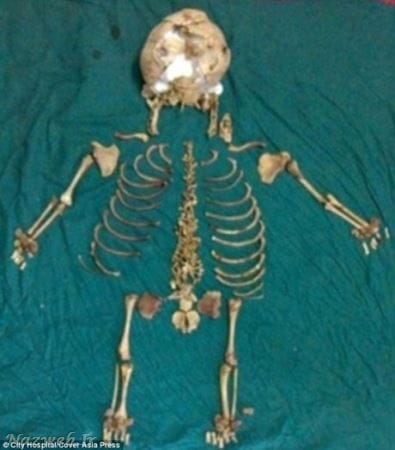جنین 38 ساله در شکم این زن ! + عکس جنین 38 ساله در شکم این زن ! + عکس