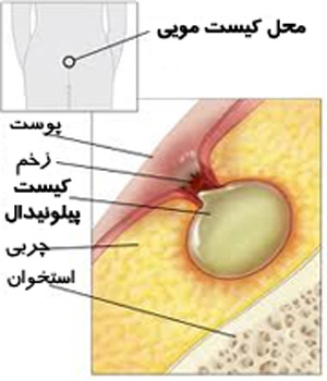آسم و آلرژی, نرمی استخوان