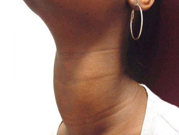 آسم و آلرژی, نرمی استخوان