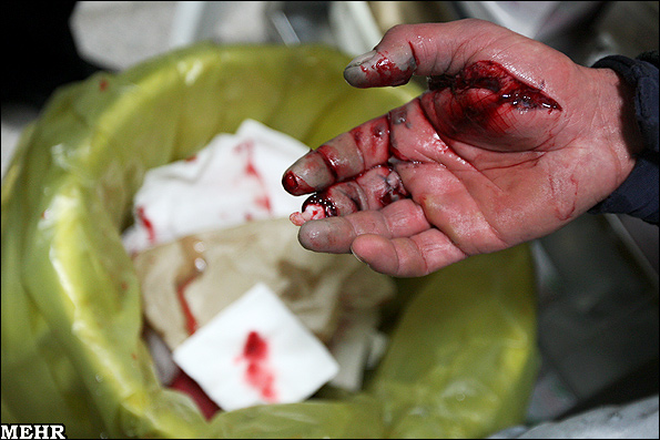 عکس های سوختگی ها و مصدومیت های چهارشنبه سوری 93