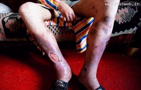 عکس های وحشتناک از مخدر کروکودیل ( 18+)