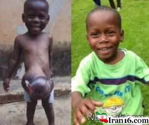 روده بیرون , exomphalos , کودک عجیب , عکس بیماری عجیب , بیرون ریختن روده از شکم , کیسه اطراف ناف , کبد بیرون از شکم پسربچه 3 ساله , جراحی سخت