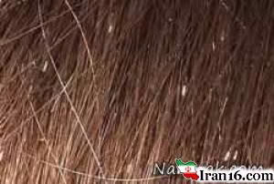 شپش موی سر و درمان , شپش , شپش موی سر , شپش