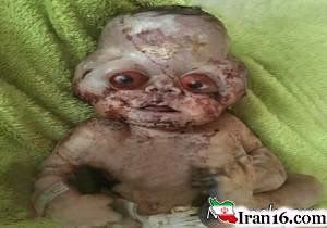 نوزاد با چهره عجیب , نوزاد , نوزاد عجیب الخلقه , نوزاد عجیب الخلقه در مازندران