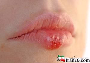 تبخال , تبخال بینی , تبخال لب , درمان تبخال در طب سنتی , درمان تبخال لب , درمان تبخال بینی , درمان تبخال با داروهای گیاهی , تبخال چگونه درمان میشود