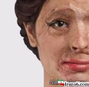 مدلینگ زیبا , عکس مدلینگ زن هندی , قربانی اسیدپاشی , مدلینگ دختر , عکس مدلینگ خارجی , صورت سوخته با اسید