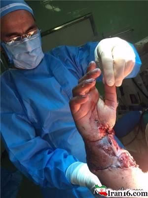 پیوند دست , پیوند دست قطع شده