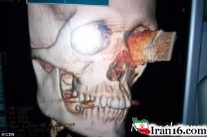 چاقو در چشم