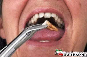 کشیدن دندان , دندان , دیه , پرداخت دیه