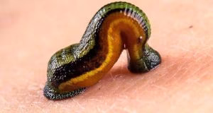 درمان سرگیجه با انداختن زالو