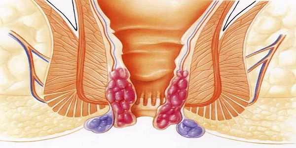 درمان بواسیر با لیزر ، درمان بواسیر با لیزر در شیراز ،هزینه درمان بواسیر با لیزر ،مرکز درمان بواسیر با لیزر در شیراز،مراکز درمان بواسیر با لیزر در شیراز،درمان بواسیر با لیزر شیراز،درمان بواسیر و شقاق با لیزر در شیراز،درمان بواسیر با لیزر،درمان بواسیر با لیزر در مشهد