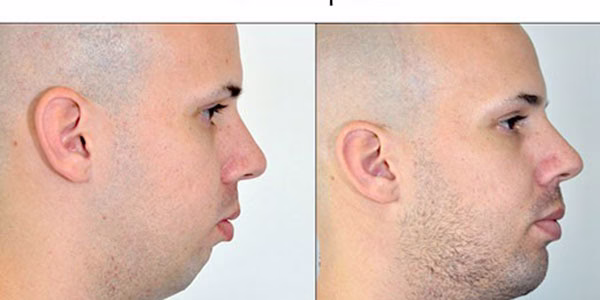 عوارض انواع جراحی و پروتز چانه و فک با تزریق ژل