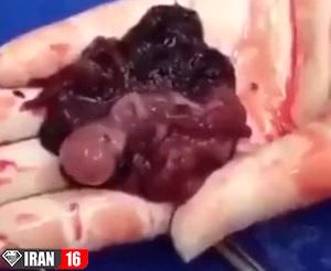 جنین سقط شده