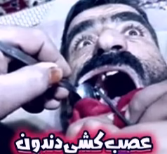 عصب کشی دندون به سبک عصر حجر 7 عصب کشی دندون به سبک عصر حجر
