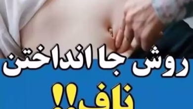جاندازی ناف ، آموزش جا انداختن ناف دررفته 1 جانداحتن ناف
